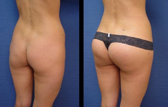 Buttocks Implants before 399986