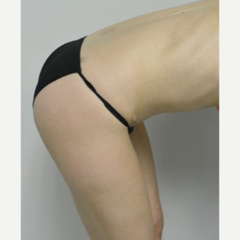 35-44 year old woman treated with Tummy Tuck after 3282984