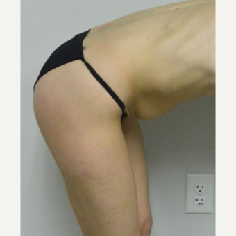 35-44 year old woman treated with Tummy Tuck before 3282984