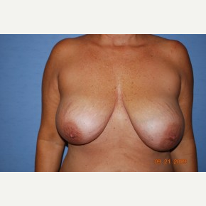35-44 year old woman treated with Breast Lift before 3781237