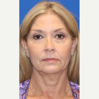 55-64 year old woman treated with Facelift before 3665974