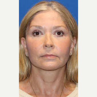 55-64 year old woman treated with Facelift after 3665974