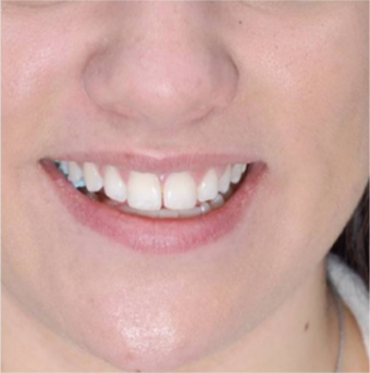 17 or under year old woman treated with Acne Treatment after 3384498