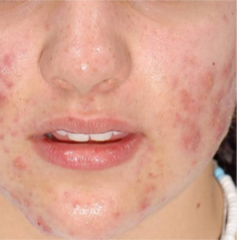 17 or under year old woman treated with Acne Treatment before 3384498