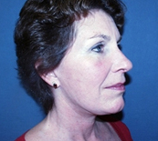 Facelift after 1130945