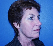Facelift before 1130945