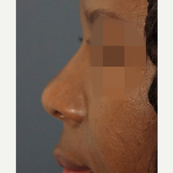 35-44 year old woman treated with Non Surgical Nose Job after 3244857