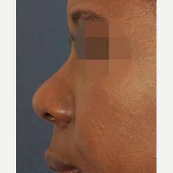35-44 year old woman treated with Non Surgical Nose Job before 3244857