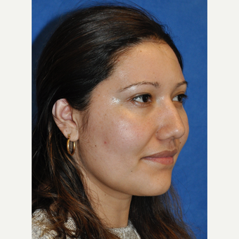 25-34 year old woman treated with Rhinoplasty after 3248052