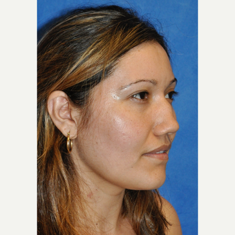 25-34 year old woman treated with Rhinoplasty before 3248052
