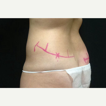 35-44 year old woman treated with CoolSculpting after 3382786