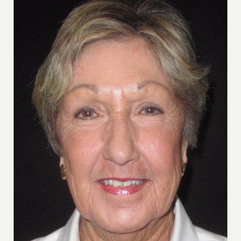 65-74 year old woman treated with MiXto Laser after 3042093