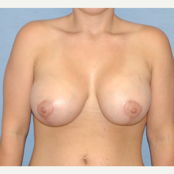 25-34 year old woman treated with Breast Lift with Implants after 3124548
