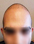 FUE – BHT Using Head, Beard and Body Hair after 196038