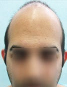 FUE – BHT Using Head, Beard and Body Hair before 196038