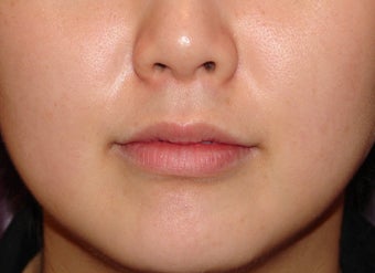 Filler for Lip Augmentation before 124032