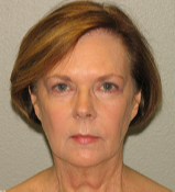 67 year old woman treated with Facelift before 3282880