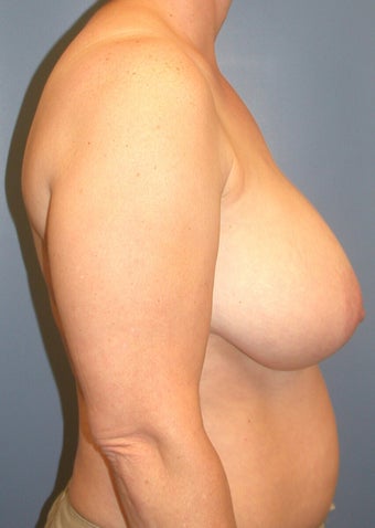 Breast Reduction DDD to C 1320365