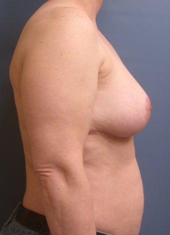 Breast Reduction DDD to C 1320365