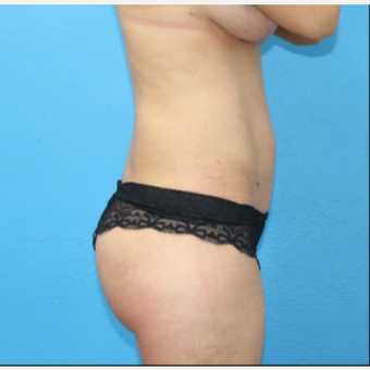 25-34 year old woman treated with Brazilian Butt Lift after 3380459