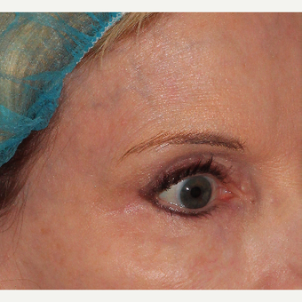 45-54 year old woman treated with CoolSculpting after 3104820