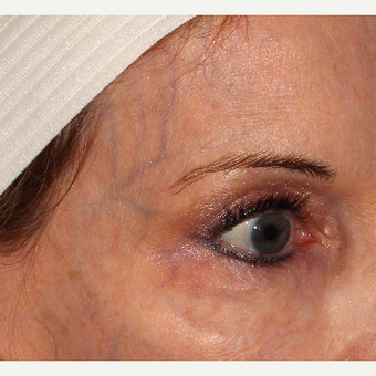 45-54 year old woman treated with CoolSculpting before 3104820