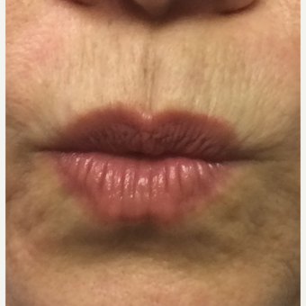 35-44 year old woman treated with Restylane Silk after 3445230