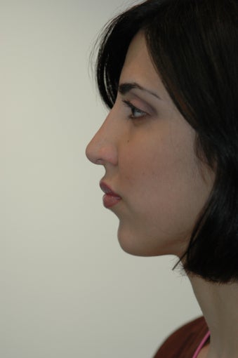 Rhinoplasty and Lip Injection after 292218
