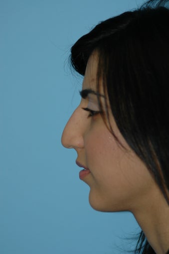 Rhinoplasty and Lip Injection before 292218