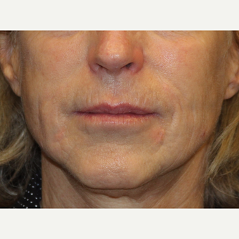 65-74 year old woman treated with Liquid Facelift after 3502710