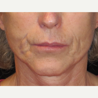 65-74 year old woman treated with Liquid Facelift before 3502710