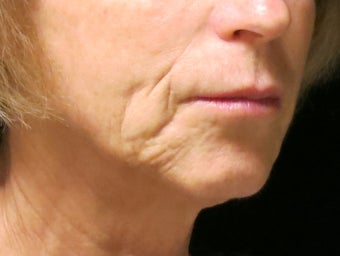 65-74 year old woman treated with Liquid Facelift 3502710