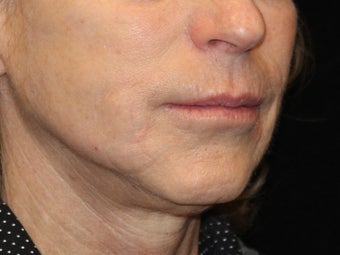 65-74 year old woman treated with Liquid Facelift 3502710