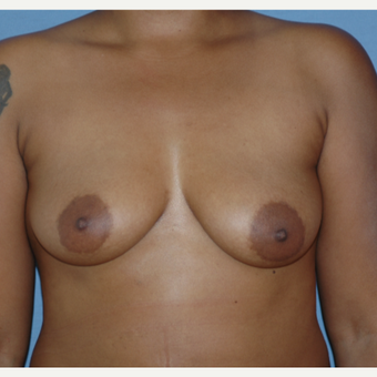 25-34 year old woman treated with Breast Augmentation before 3378438