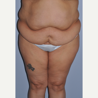 35-44 year old woman treated with Tummy Tuck before 3584275