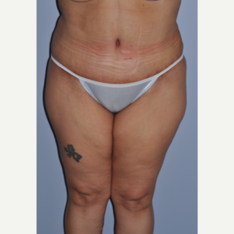 35-44 year old woman treated with Tummy Tuck after 3584275