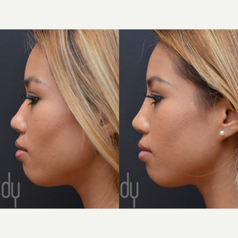 Non Surgical Nose Job before 3622613