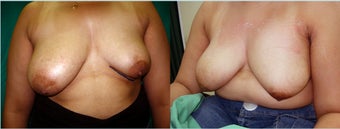 32 years female had unilateral hypoplasia of left breast reconstructed with silicone gel implant 350 ccc before 932201