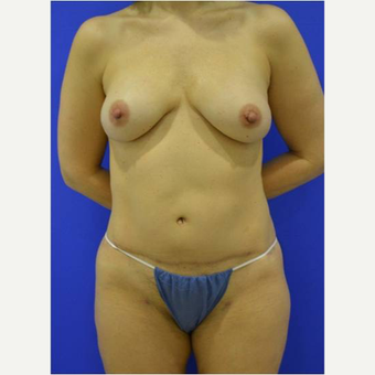 48 year old woman treated with Breast Reconstruction Revision after 3725269