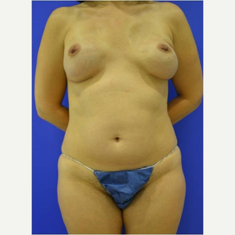 48 year old woman treated with Breast Reconstruction Revision before 3725269