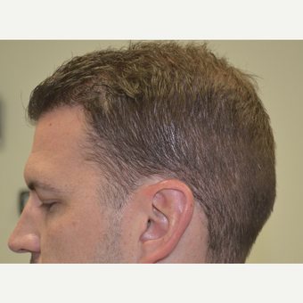 35-44 year old man treated with FUE Hair Transplant after 3080149