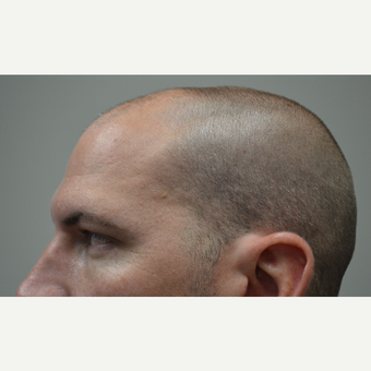 35-44 year old man treated with FUE Hair Transplant before 3080149