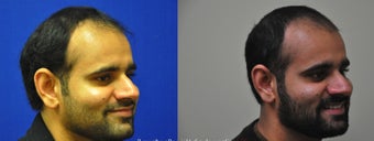 Right Sided Dimple Creation Surgery 505691