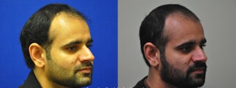 Right Sided Dimple Creation Surgery 505691