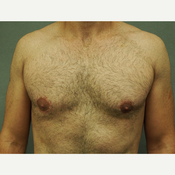 25-34 year old man treated with Male Breast Reduction after 3616902