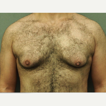 25-34 year old man treated with Male Breast Reduction before 3616902