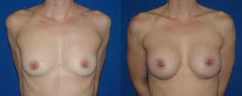 32 year old woman treated with Breast Augmentation before 2990300