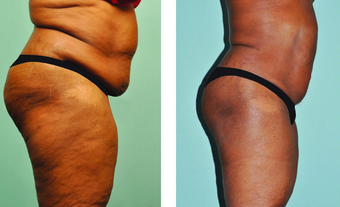 Smartlipo abdomen, hips & mons 3 mos post treatment -61 yr. old after 696012