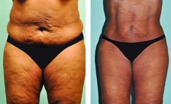 Smartlipo abdomen, hips & mons 3 mos post treatment -61 yr. old before 696012