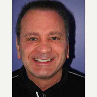 64 year old man treated with Facelift after 3710814